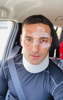 Scaloni golpeado.jpg