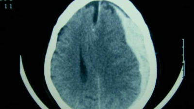 ¿Qué es un hematoma subdural?