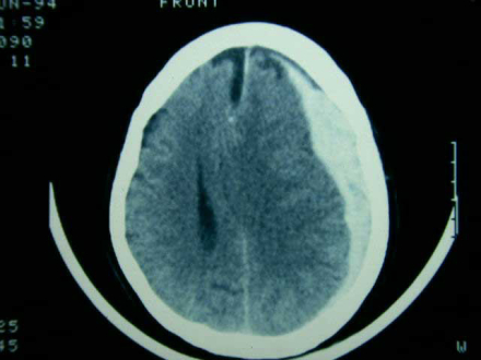 hematoma-subdural-aguda.jpg