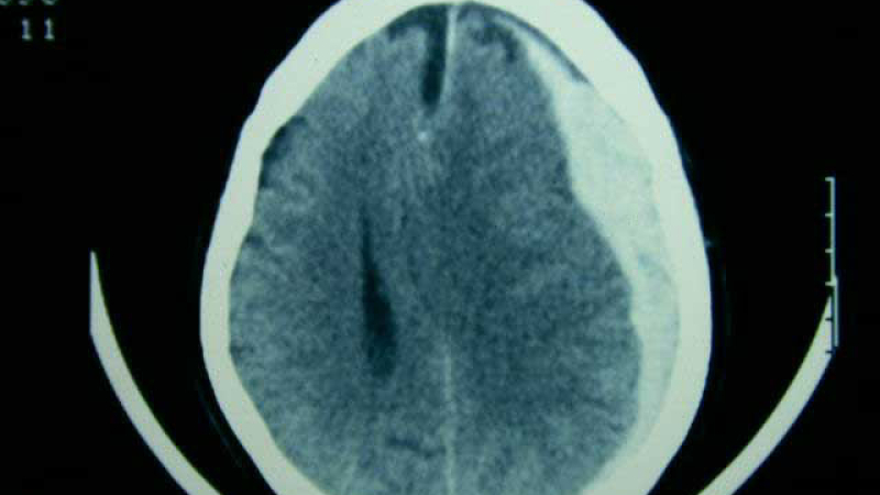 ¿Qué es un hematoma subdural?