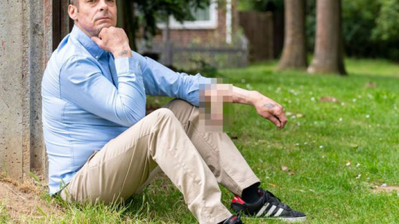 Un hombre tuvo que vivir durante seis años con el pene injertado en su brazo