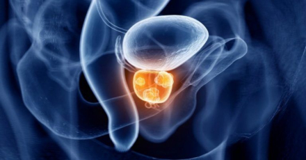 prostata-cancer.jpg