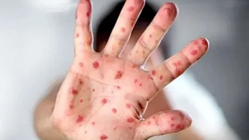 Viruela del mono: detectaron el primer caso en Argentina de la variante más agresiva y contagiosa