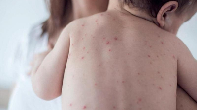 Alerta por un caso de sarampión: qué medidas y previsiones se aconsejan