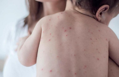 Alerta por un caso de sarampión: qué medidas y previsiones se aconsejan