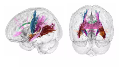 Los cambios que "esculpen" el cerebro de la madre durante el embarazo