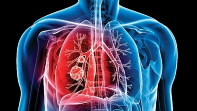 Aumentan casos de tuberculosis en la Argentina