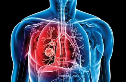 tuberculosis3.jpg