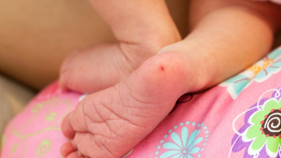 Fenilcetonuria: una enfermedad poco frecuente con consecuencias prevenibles