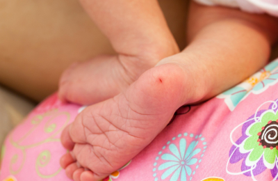 Fenilcetonuria: una enfermedad poco frecuente con consecuencias prevenibles