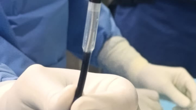 Se realizó el primer implante de marcapasos sin cables en el Hospital de Alta Complejidad