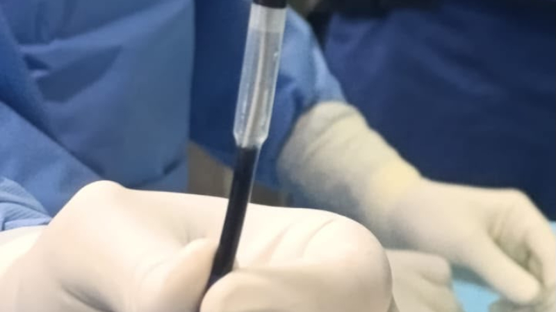 Se realizó el primer implante de marcapasos sin cables en el Hospital de Alta Complejidad