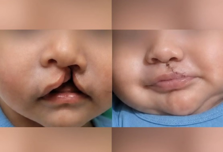 labio1