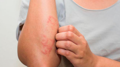 La provincia adhiere a la Campaña Nacional de Psoriasis