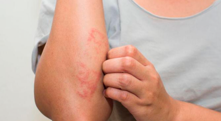 Psoriasis.png