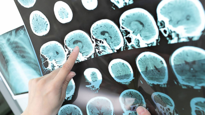 Farmacéutica ocultó un fármaco que podría prevenir el alzhéimer