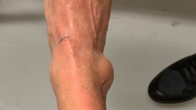 Así quedó el tobillo de Neymar