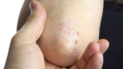 Tratar la psoriasis en equipo, eje de la campaña de este año