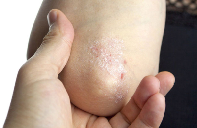 Tratar la psoriasis en equipo, eje de la campaña de este año