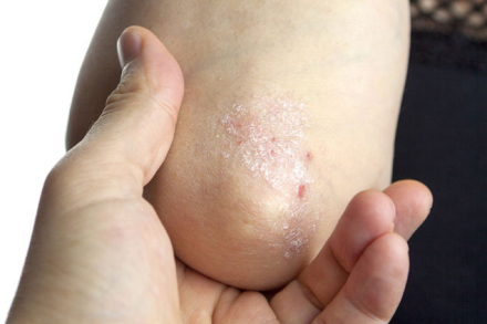 psoriasis-.jpg