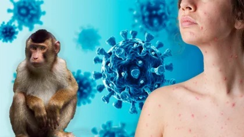 OMS: viruela del mono es emergencia sanitaria internacional