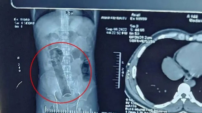 Estuvo tres semanas con un desodorante en el ano