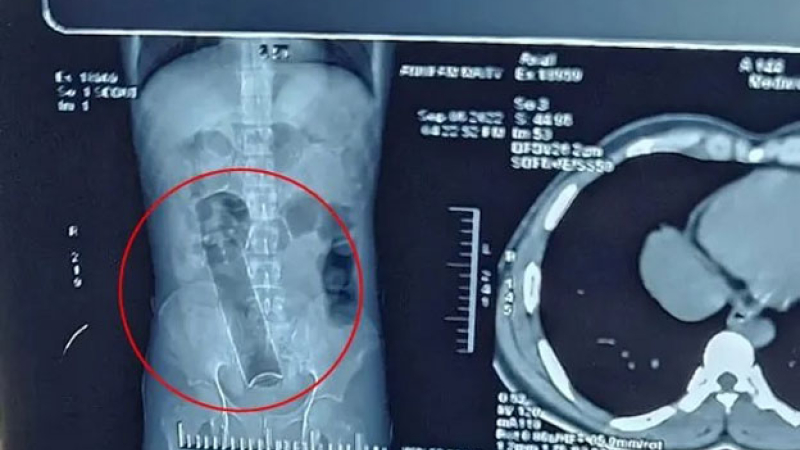 Estuvo tres semanas con un desodorante en el ano