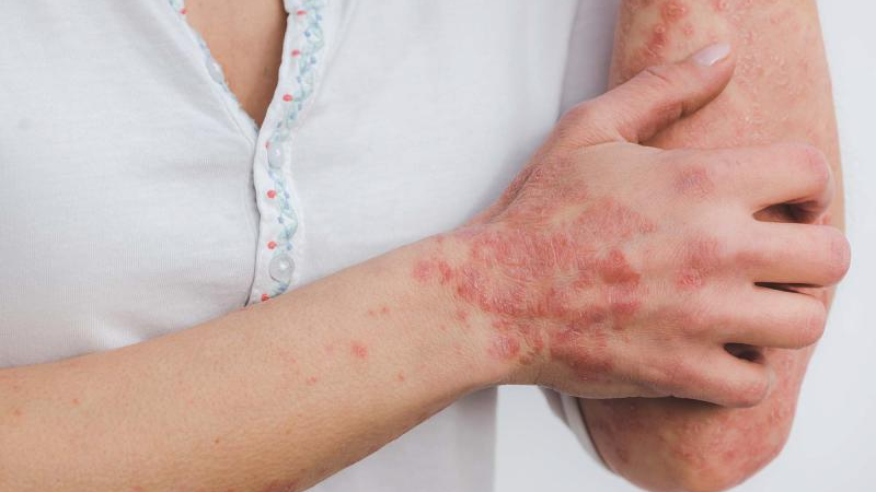 Plus médico y otros gastos extras complican a pacientes con psoriasis