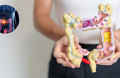 Ensayan medicamento para eliminar el cáncer de colon sin cirugía