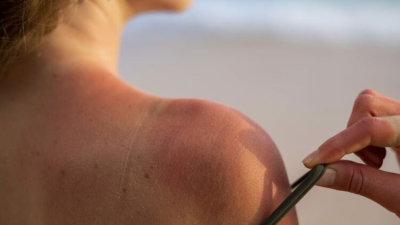 El cuidado de la piel ante las altas temperaturas y la exposición al sol