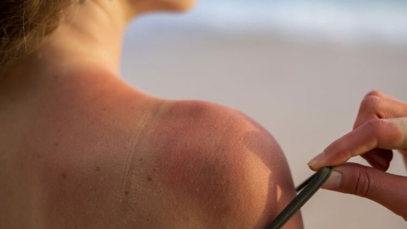 El cuidado de la piel ante las altas temperaturas y la exposición al sol