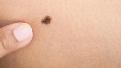 Preocupa el aumento de casos de cáncer de piel en el Chaco