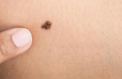 Preocupa el aumento de casos de cáncer de piel en el Chaco