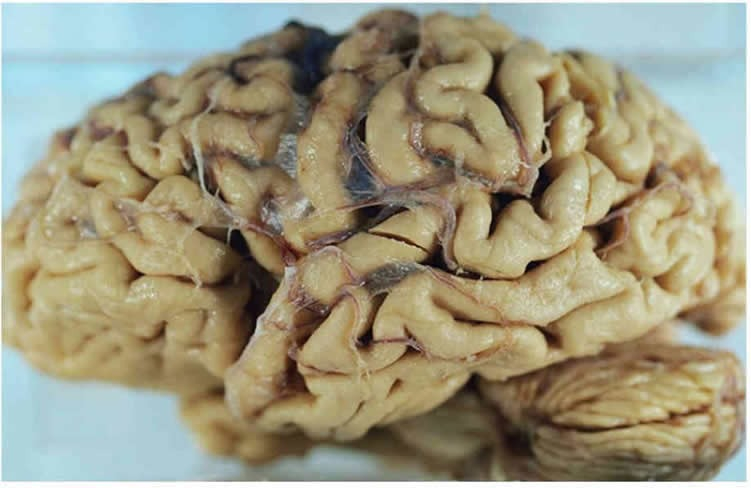 alzheimer2.jpg