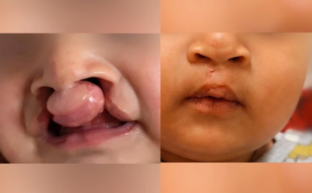 labio