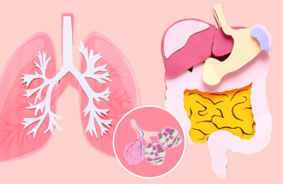 Día Mundial de la Fibrosis Quística: los avances que cambiaron la vida de los pacientes