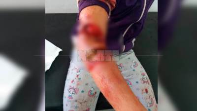 Niña de 8 años sufrió graves heridas en un brazo cuando fue mordida por un perro