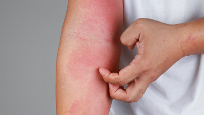 Lanzan guías con consejos prácticos y detalles para tratar la dermatitis atópica