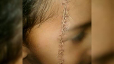 Maltrato infantil: un niño sufrió un corte con una hoja de afeitar en su rostro