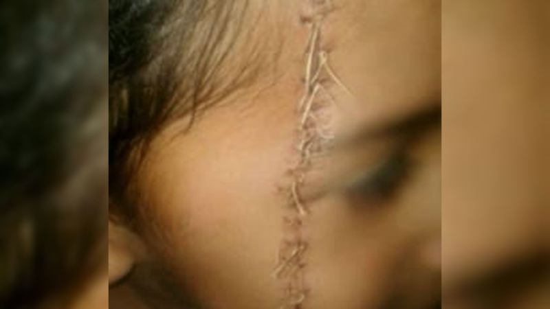 Maltrato infantil: un niño sufrió un corte con una hoja de afeitar en su rostro