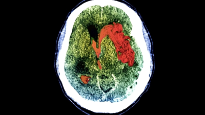 Una cuarta parte de las personas que no responden a las lesiones cerebrales están conscientes