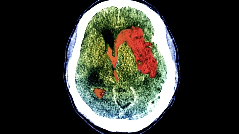 Una cuarta parte de las personas que no responden a las lesiones cerebrales están conscientes