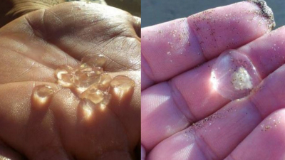 Las picaduras en las playas de la costa atlántica