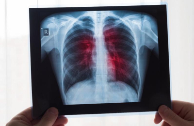 Una nueva esperanza en el tratamiento para el cáncer de pulmón