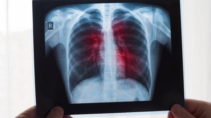 Una nueva esperanza en el tratamiento para el cáncer de pulmón