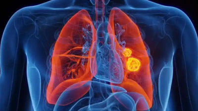 Un nuevo blanco terapéutico para el cáncer de pulmón