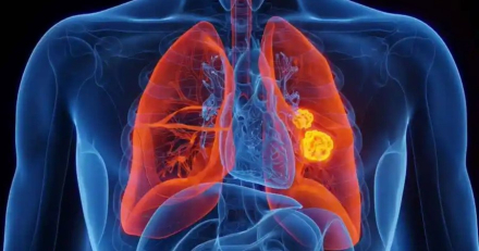cáncer de pulmón.jpg
