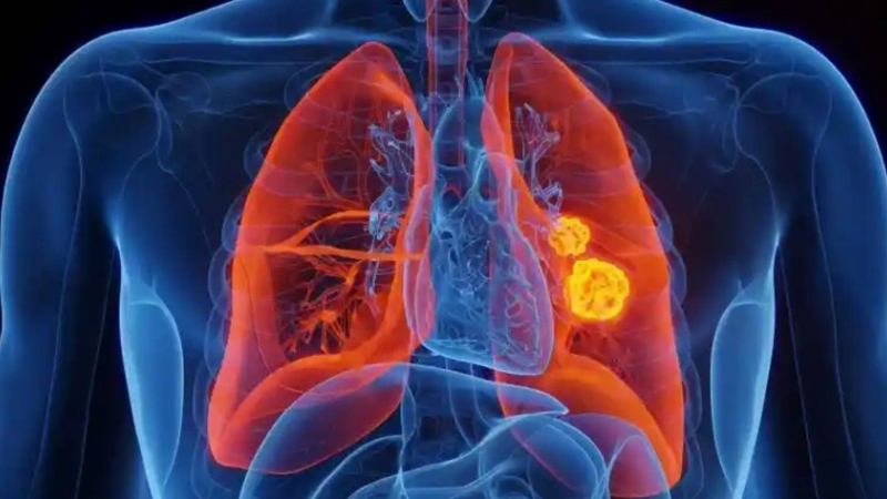 Un nuevo blanco terapéutico para el cáncer de pulmón