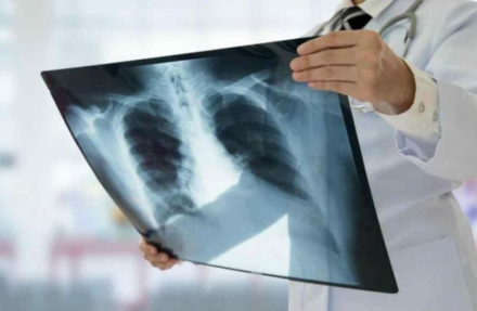 tuberculosis5.jpg