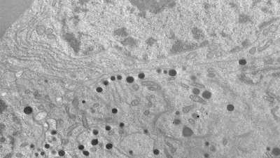Descubren elementos para frenar tumores intracraneales